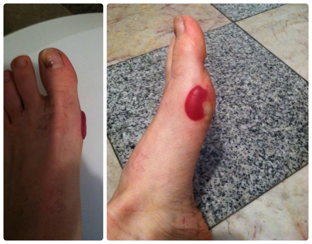 Runner's Feet 101: Blisters