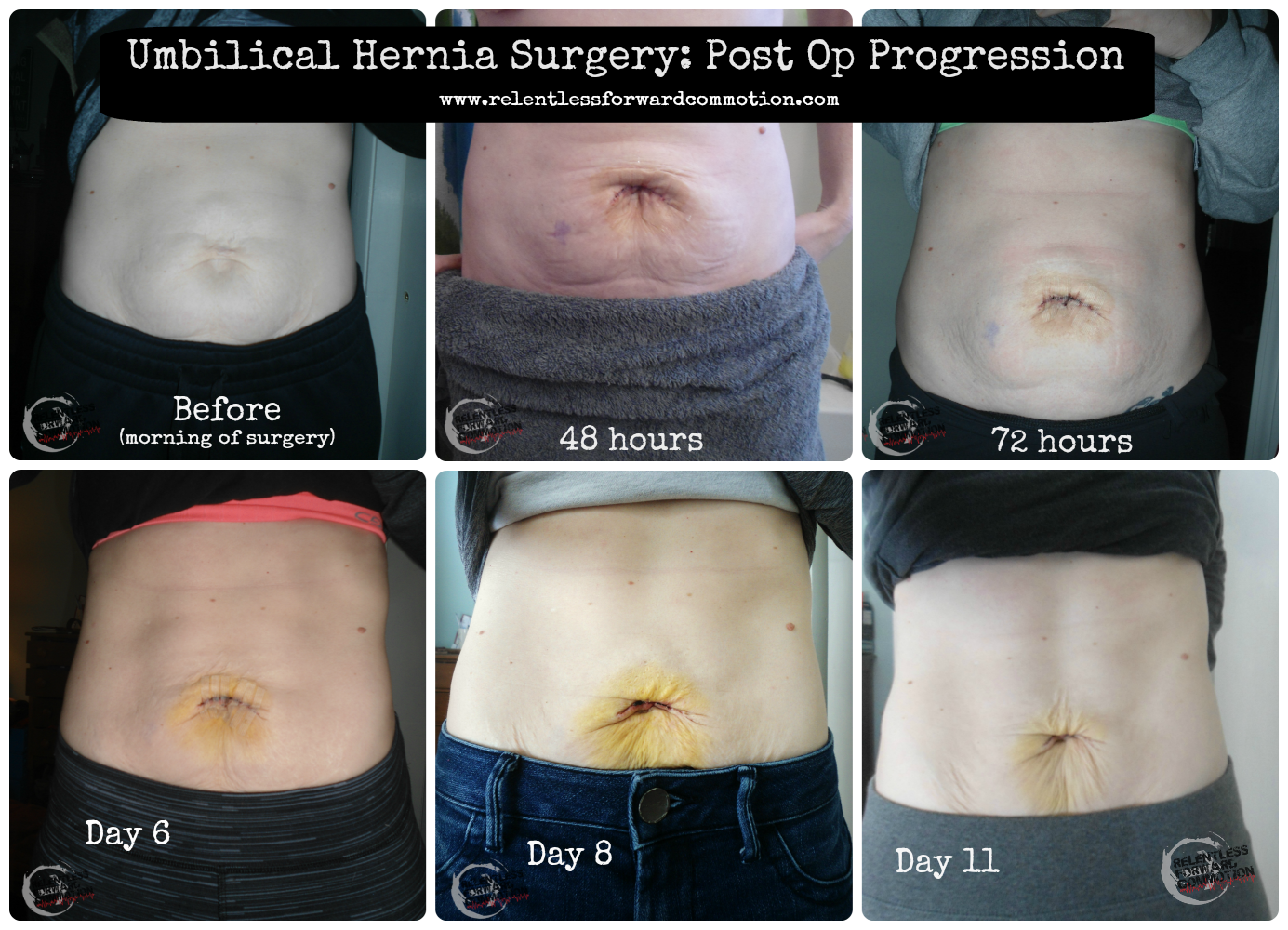 Umbilical Hernia Surgery Recovery Progression