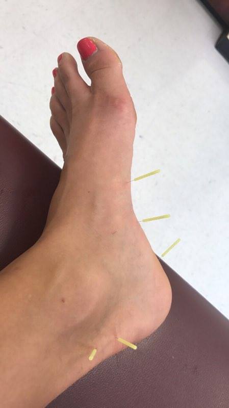 Running injury resulting in acupuncture needles in a foot and ankle 