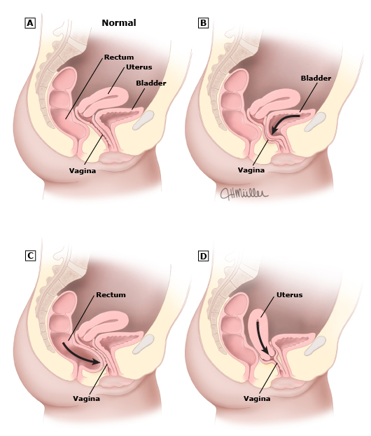 Pelvic organ prolapse examples