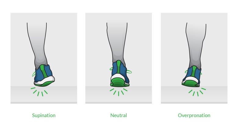 Diagram of foot demonstrating supination, neutral foot, and overpronation in runners