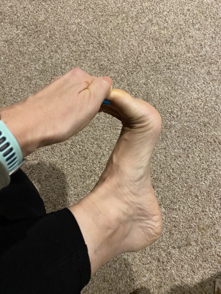 Runner stretches arches of feet to help alleviate plantar fasciitis pain